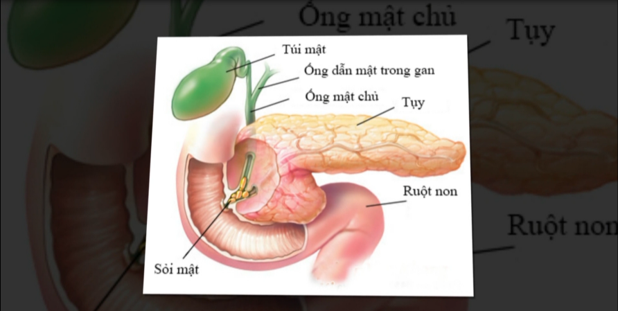 Nhịp cầu y tế - Điều trị viêm túi mật 27-06-2016