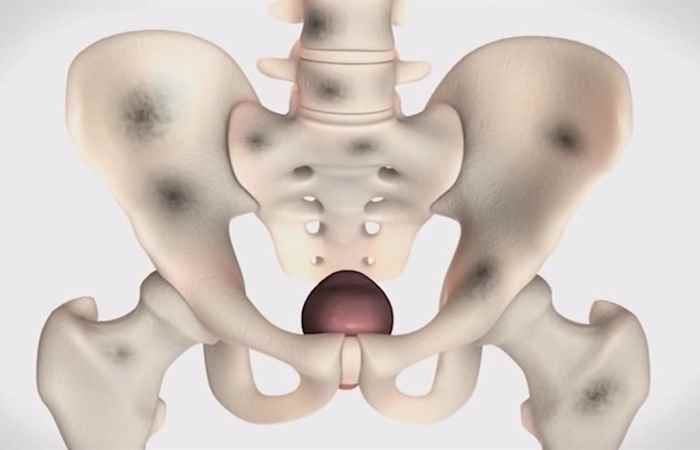 Nhịp cầu sức khỏe - Ung thư xương ở trẻ em không thể coi thường 05-04-2018