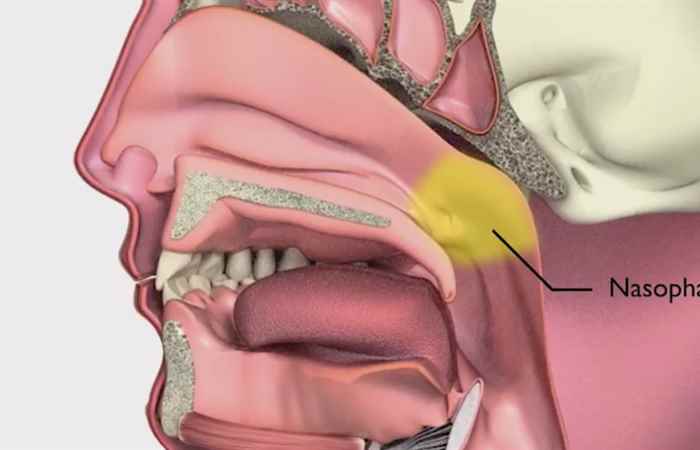 Nhịp cầu sức khỏe U xơ vòm mũi họng có điều trị được triệt để 10-10-2018