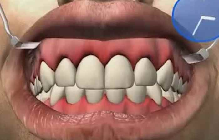 Nhịp cầu sức khỏe Mức độ nghiêm trọng của viêm nướu phì đại 14-12-2018