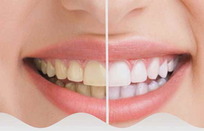 Nhịp cầu sức khỏe - Răng ngả màu tại sao?19-07-2018