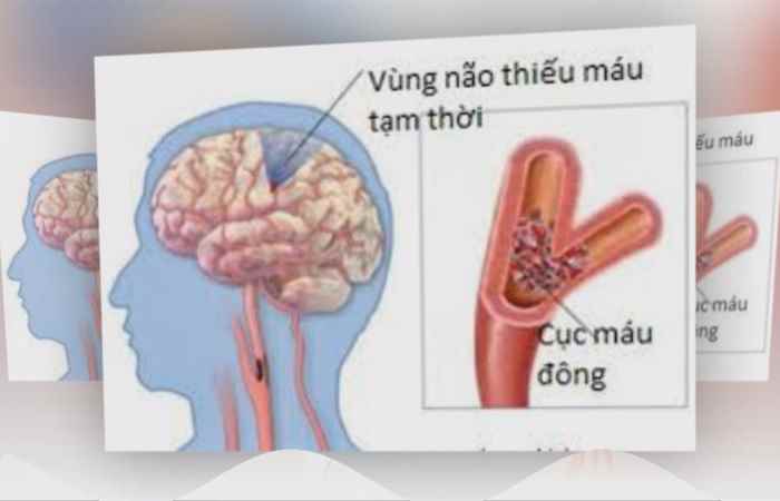Nhịp cầu sức khỏe Chớ xem thường thểu năng tuần hoàn não 20-09-2018