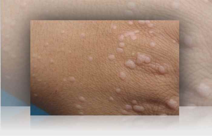 Nhịp cầu sức khỏe Loại bỏ mụn cơm không để lại sẹo 02-09-2018