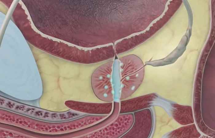 Nhịp cầu sức khỏe Những điều nam giới cần biết về ung thư tuyến tuyền liệt 17-09-2018