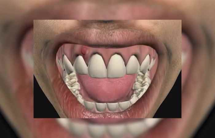 Nhịp cầu sức khỏe - Thế nào là áp xe răng 03-04-2018