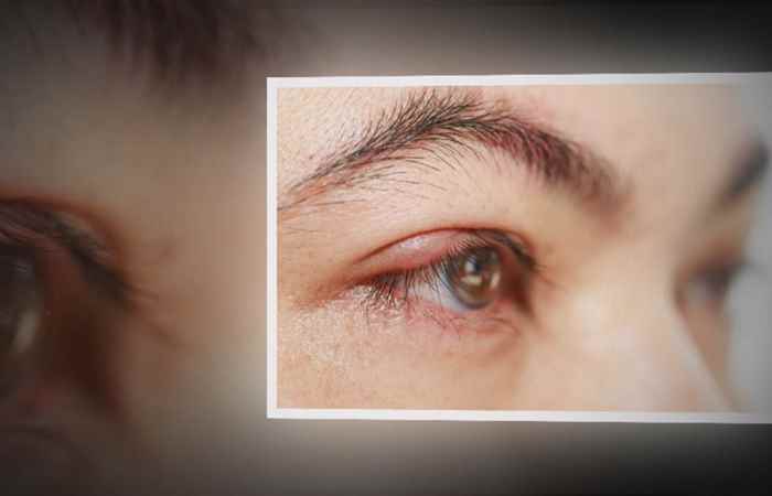 Nhịp cầu sức khỏe - Viêm kết mạc dị ứng liệu có chữa được dứt điểm 23-07-2018