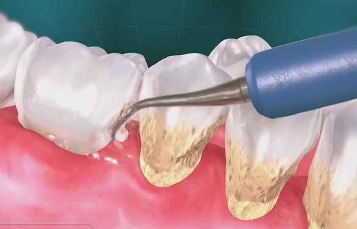 Nhịp cầu sức khỏe - Vôi răng nguyên nhân hàng đầu gây bệnh răng miệng 24-07-2018