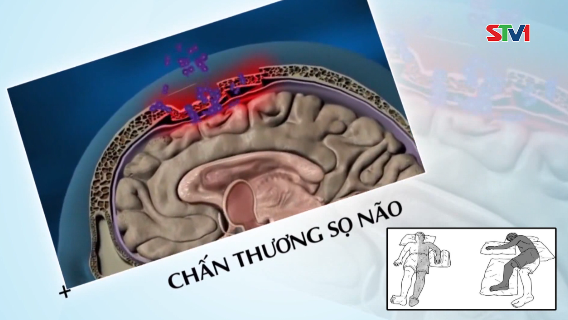 Nhịp cầu y tế - Phòng tránh và điều trị bệnh liệt nữa người 07-10-2016