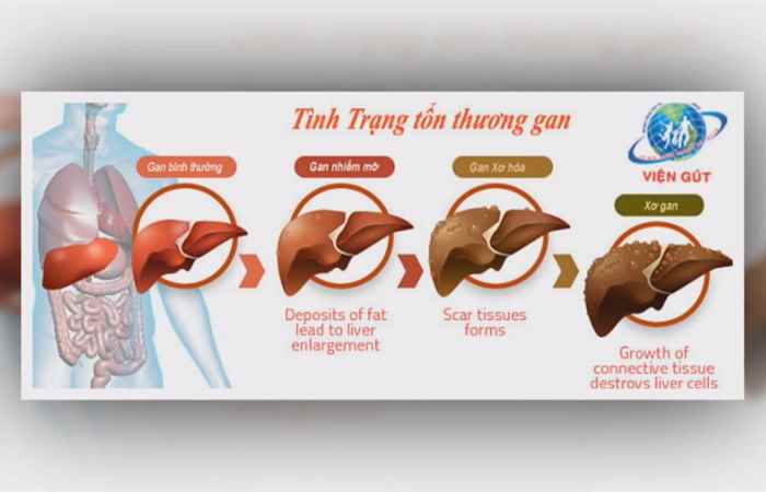 Nhịp cầu y tế - Củ nén trị mụn trứng cá 17-04-2017