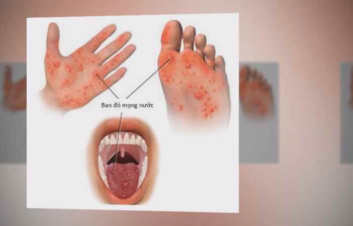 Nhịp cầu y tế - Hạt trắc bách diệp giúp nhuận tràng 08-10-2017