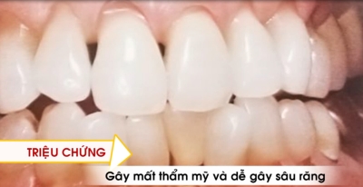 Nhịp cầu y tế- Phòng và điều trị mòn răng 09-06-2016