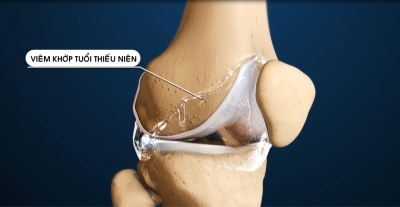 Nhịp cầu y tế - Viêm khớp tuổi thiếu niên và cách phòng tránh 08-06-2016