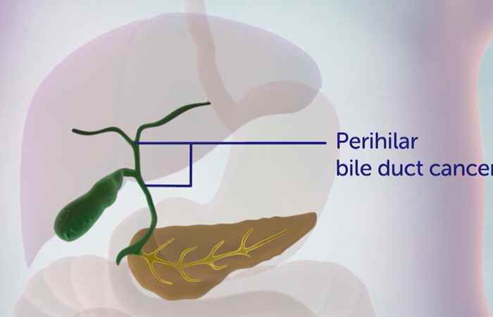 Sống khỏe 360 - Điều trị ung thư đường mật (12-12-2019)