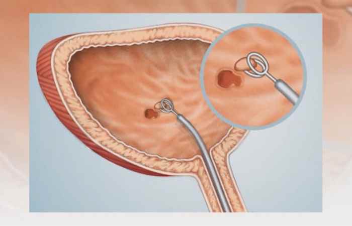 Sống khỏe 360 Những triệu chứng sỏi bàng quang không thể bỏ qua 04-06-2019