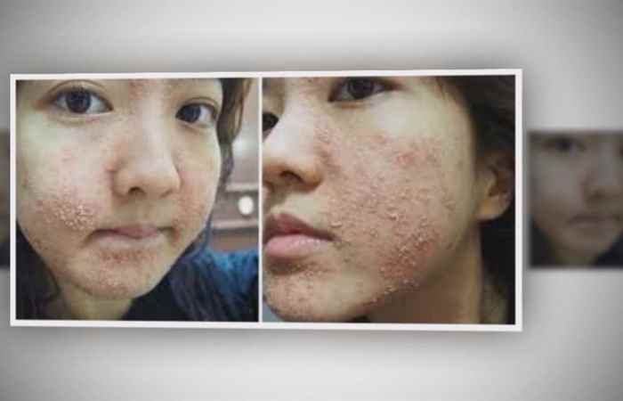 Sống khỏe 360 Hãi hùng hậu quả kem trộn 07-03-2019