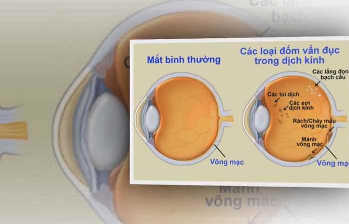 Sống khỏe 360 Ruồi bay trong mắt khắc phục như thế nào 14-01-2019