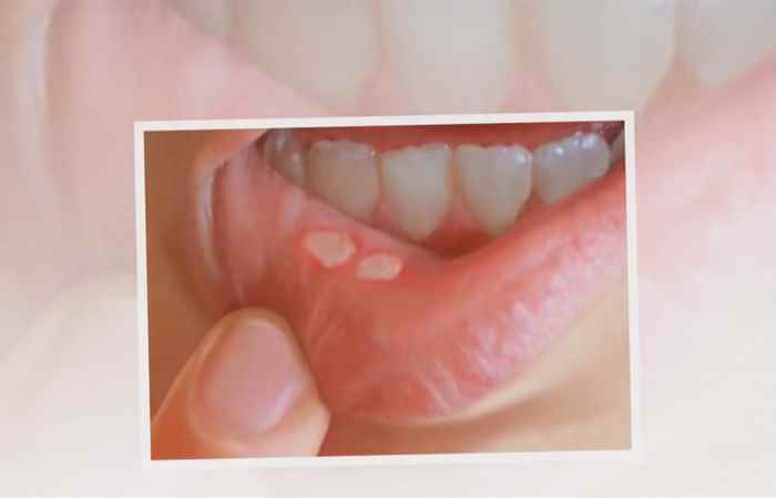 Sống khỏe 360 - Phòng và điều trị sớm bệnh viêm loét miệng 16-10-2019