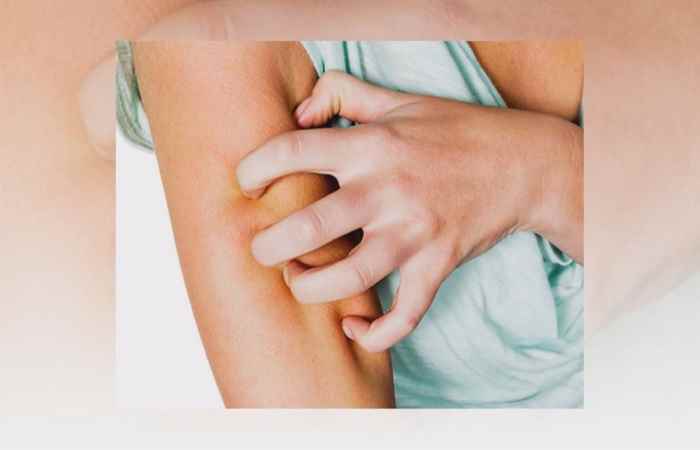 Bệnh Hắc lào có chữa khỏi được không? (Sống khỏe 360 ngày 19-07-2019)