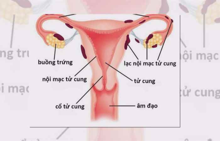 Sống khỏe 360 - Viêm nội mạc tử cung bệnh phụ nữ dễ mắc (19-11-2019)