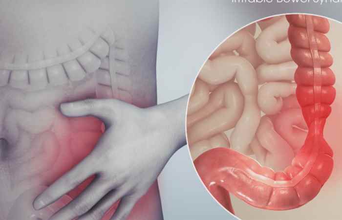 Sống khỏe 360 - Hội chứng ruột kích thích là gì (22-11-2019)