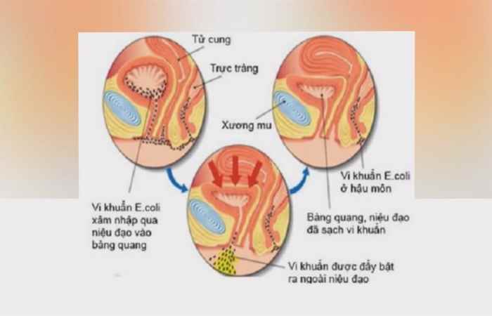 Sống khỏe 360 - Nhiễm khuẩn tiết niệu dưới ở trẻ (23-12-2019)