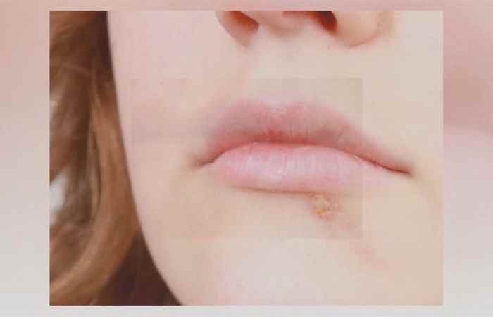 Sống khỏe 360 Viêm miệng do Herpes nhiễm một lần mắc cả đời 26-04-2019