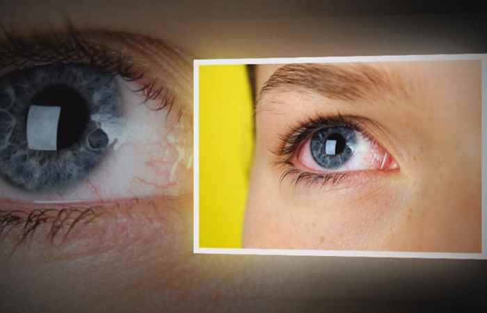 Đau mắt đỏ bệnh thường gặp trong mùa hè (Sống khỏe 360 - ngày 30-07-2019)