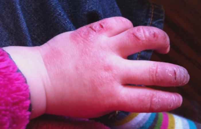 Sống khỏe 360 - Chàm - Eczema bệnh viêm da không thể coi thường 11-07-2019