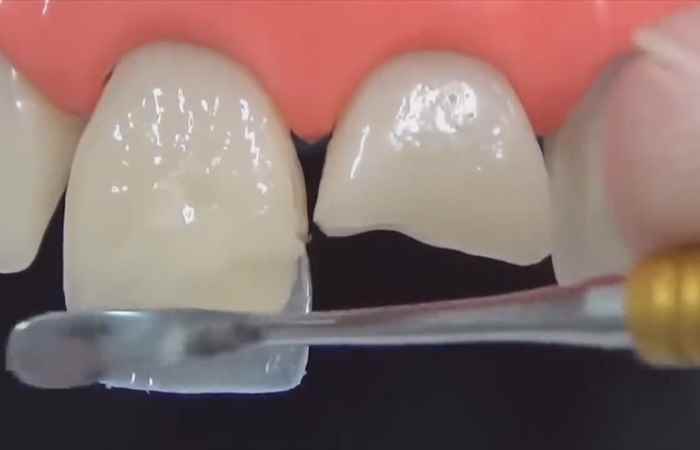 Sống khỏe 360 Chạy đua thẩm mỹ răng sứ 16-01-2019
