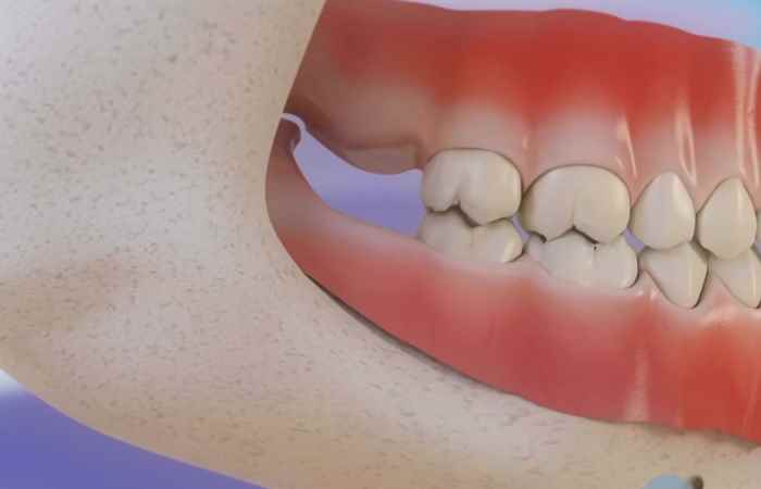 Sống khỏe 360 - Để răng khôn không còn là nỗi lo  