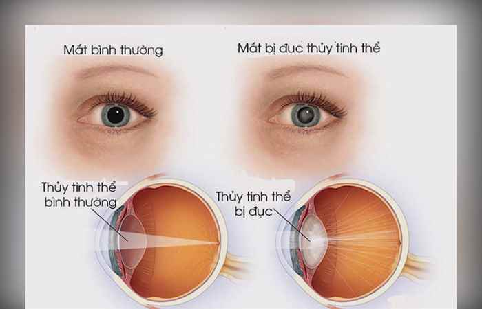 Sống khỏe 360 - Đục thủy tinh thể ở trẻ em 12-11-2019