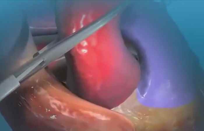 Sống khỏe 360 Hẹp van tim thủ phạm gây biến chứng chết người 04-01-2019