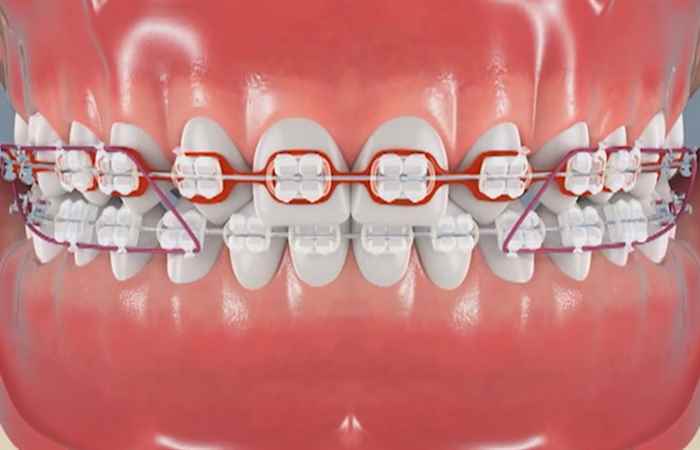 Làm gì để lấy lại tự tin khi bị phanh môi bám thấp (Sống khỏe 360 - 13-07-2019)