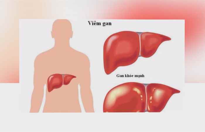 Sống khỏe 360 - Men gan tăng ảnh hưởng như thế nào 20-12-2019