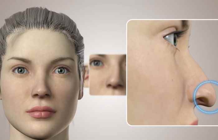 Sống khỏe 360 - Phương pháp trị lệch vách ngăn mũi hiệu quả 12-07-2019