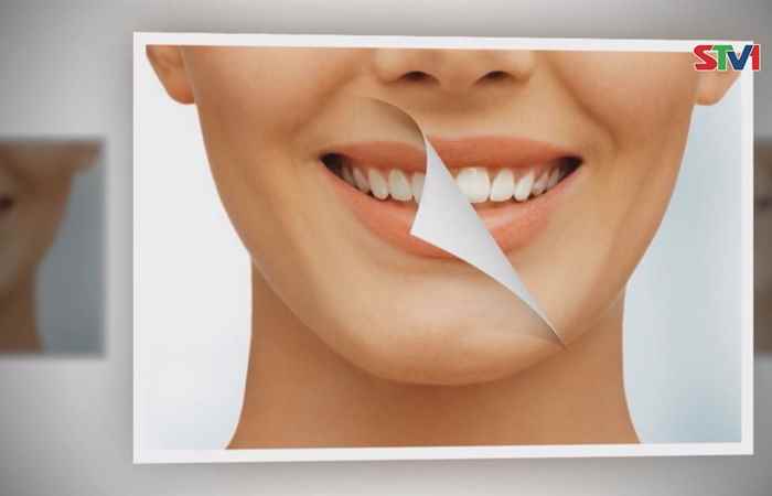 Sống khỏe 360 - Tẩy trắng răng - Ai nên, ai không 21-01-2019
