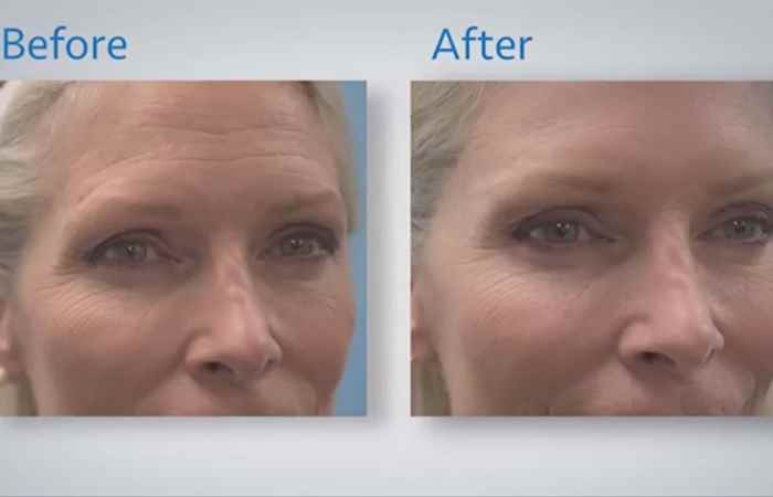 Sống khỏe 360 Tiêm botox lợi hại ra sao? 11-03-2019