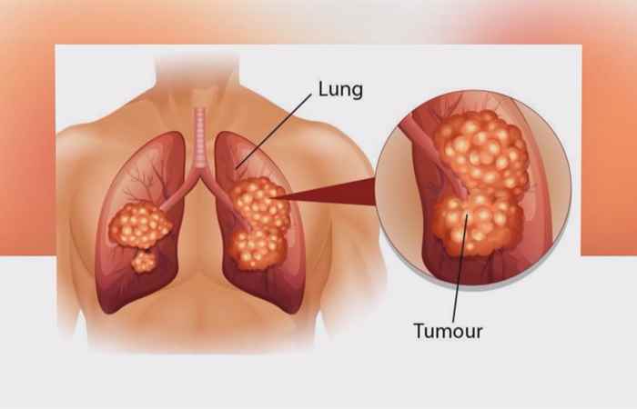 Sống khỏe 360 - Ung thư phổi có chữa khỏi được không? (02-03-2020)