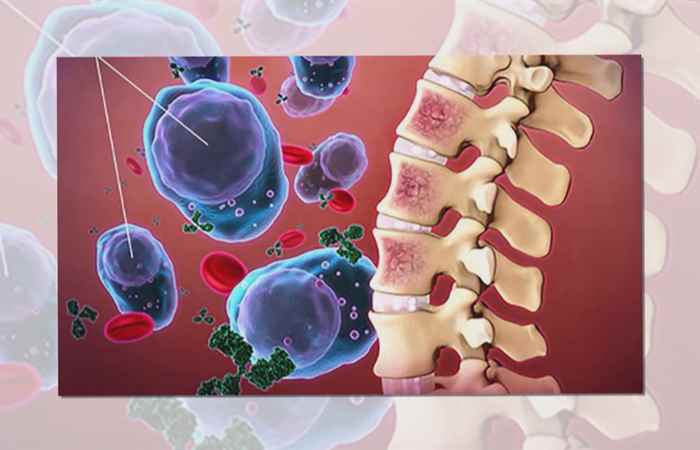 Sống khỏe 360 - Ung thư tủy xương có chữa được không? 27-11-2019