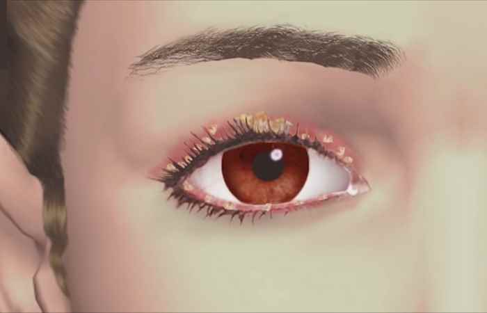 Sống khỏe 360 - Viêm bờ mi điều trị thế nào 30-10-2019