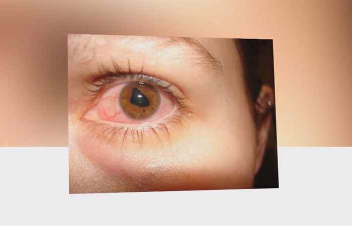 Sống khỏe 360 - Viêm móng mắt có thể dẫn đến mù lòa (15-03-2020)