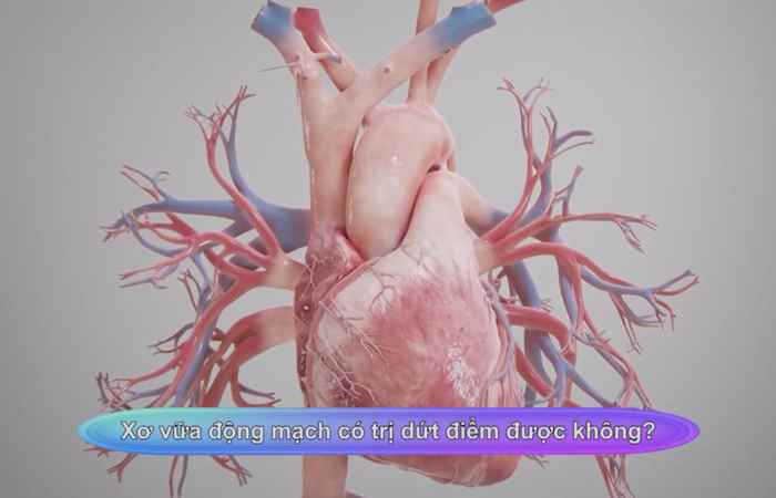 Sống khỏe 360 - Xơ vữa động mạch có trị dứt điểm được không? (28-02-2020)