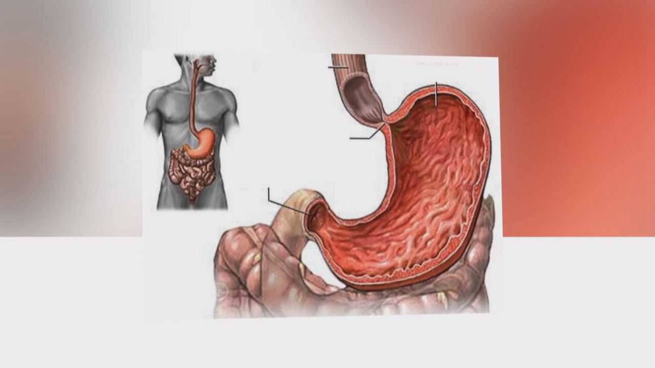 Nhịp cầu y tế - Nhận biết và điều trị co thắt thực quản 08-09-2016