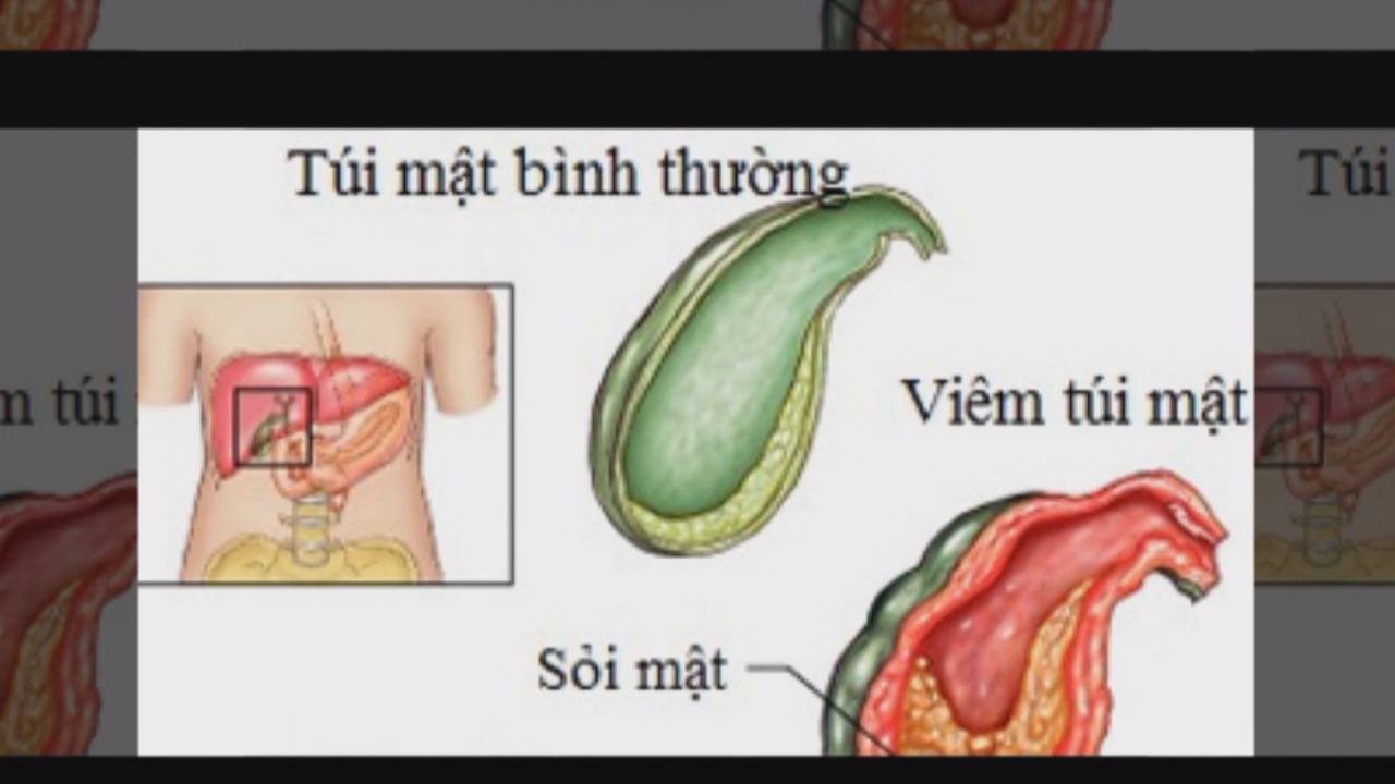 Nhịp cầu y tế - Nhận biết và điều trị Viêm túi mật ở trẻ 23-09-2016