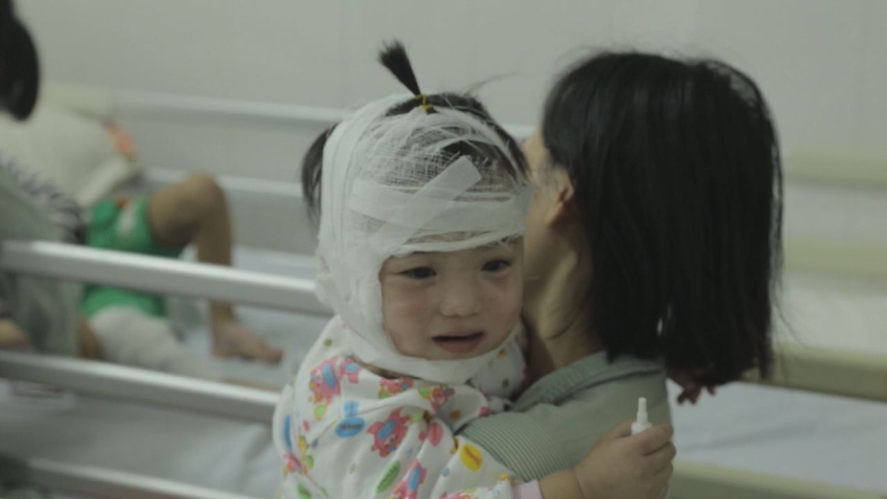 Nhịp cầu y tế - Bỏng ở trẻ em nguyên nhân và cách điều trị 18-10-2016